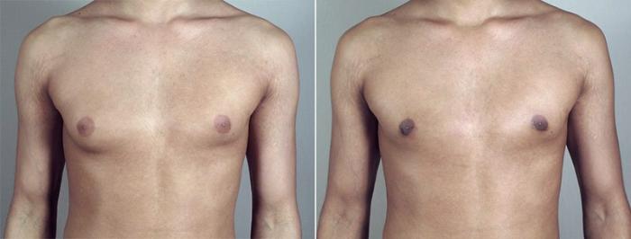 Gynecomastia Surgery Case 657 Before & After View #1 | Paramus, New Jersey | Parker Center for Plastic Surgery