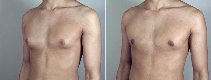 Gynecomastia Surgery Case 657 Before & After View #2 | Paramus, New Jersey | Parker Center for Plastic Surgery