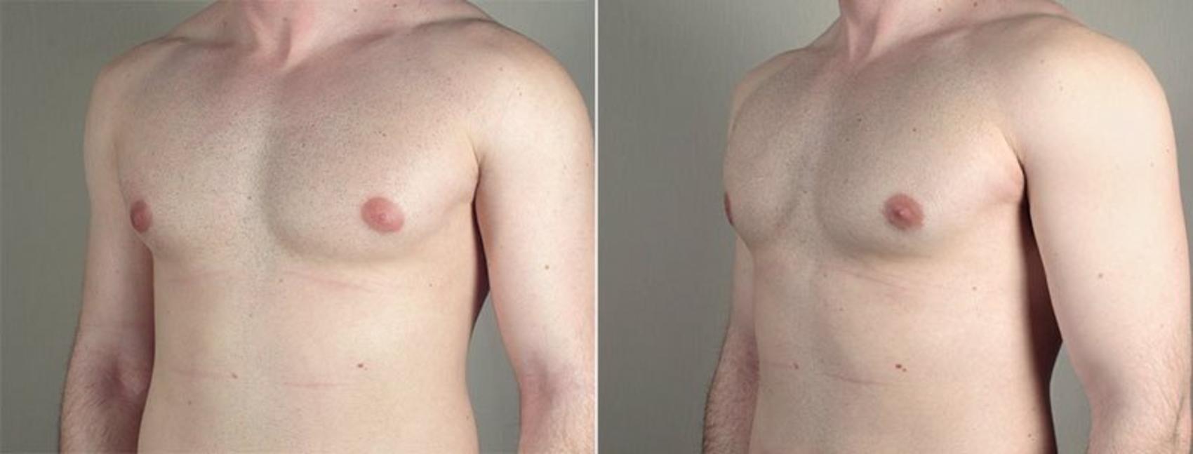 Gynecomastia Surgery Case 658 Before & After View #1 | Paramus, New Jersey | Parker Center for Plastic Surgery
