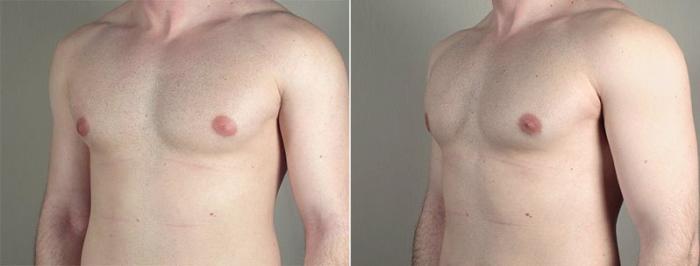 Gynecomastia Surgery Case 658 Before & After View #1 | Paramus, New Jersey | Parker Center for Plastic Surgery