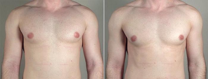 Gynecomastia Surgery Case 658 Before & After View #2 | Paramus, New Jersey | Parker Center for Plastic Surgery