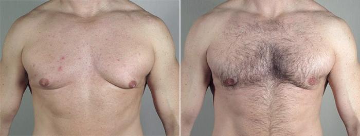 Gynecomastia Surgery Case 659 Before & After View #1 | Paramus, New Jersey | Parker Center for Plastic Surgery