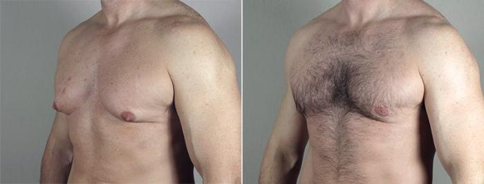 Gynecomastia Surgery Case 659 Before & After View #2 | Paramus, New Jersey | Parker Center for Plastic Surgery