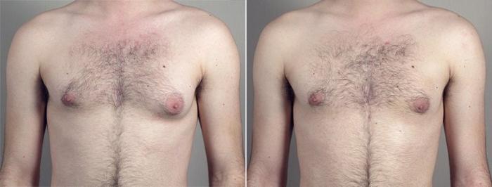 Gynecomastia Surgery Case 660 Before & After View #2 | Paramus, New Jersey | Parker Center for Plastic Surgery