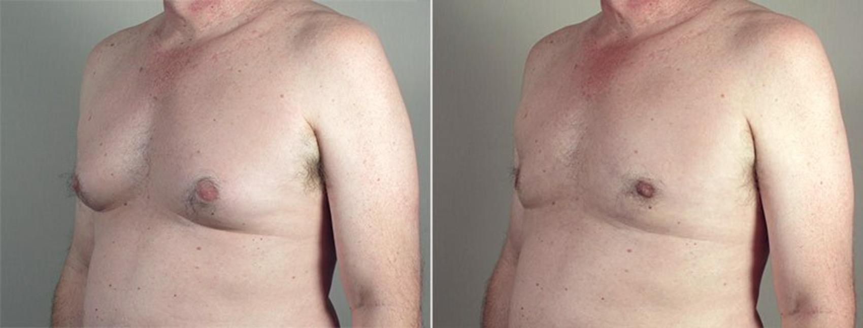 Gynecomastia Surgery Case 662 Before & After View #1 | Paramus, New Jersey | Parker Center for Plastic Surgery
