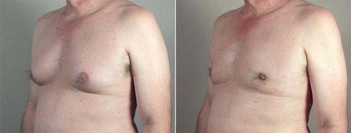 Gynecomastia Surgery Case 662 Before & After View #1 | Paramus, New Jersey | Parker Center for Plastic Surgery