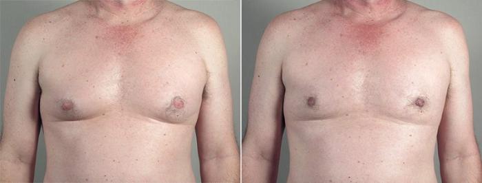Gynecomastia Surgery Case 662 Before & After View #2 | Paramus, New Jersey | Parker Center for Plastic Surgery