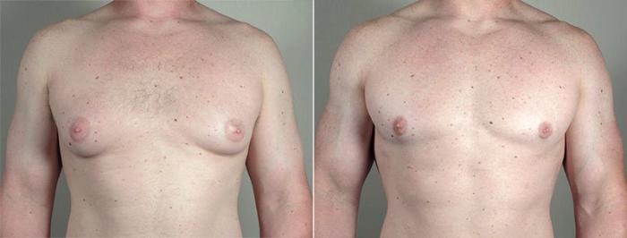 Gynecomastia Surgery Case 663 Before & After View #1 | Paramus, New Jersey | Parker Center for Plastic Surgery