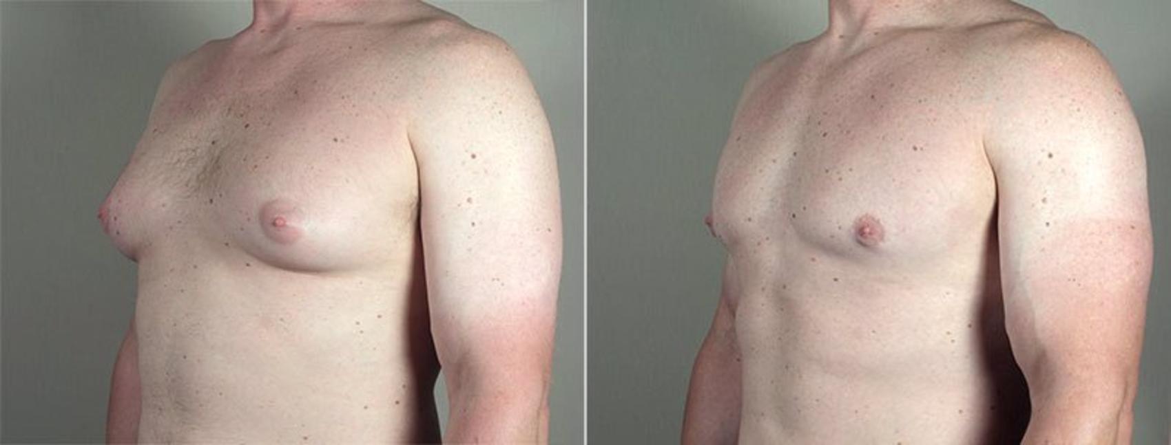 Gynecomastia Surgery Case 663 Before & After View #2 | Paramus, New Jersey | Parker Center for Plastic Surgery