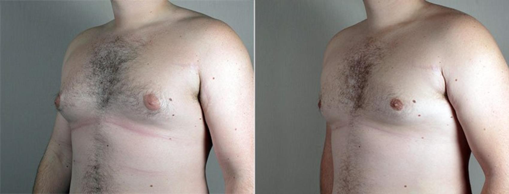 Gynecomastia Surgery Case 664 Before & After View #1 | Paramus, New Jersey | Parker Center for Plastic Surgery