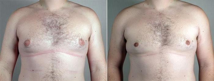 Gynecomastia Surgery Case 664 Before & After View #2 | Paramus, New Jersey | Parker Center for Plastic Surgery