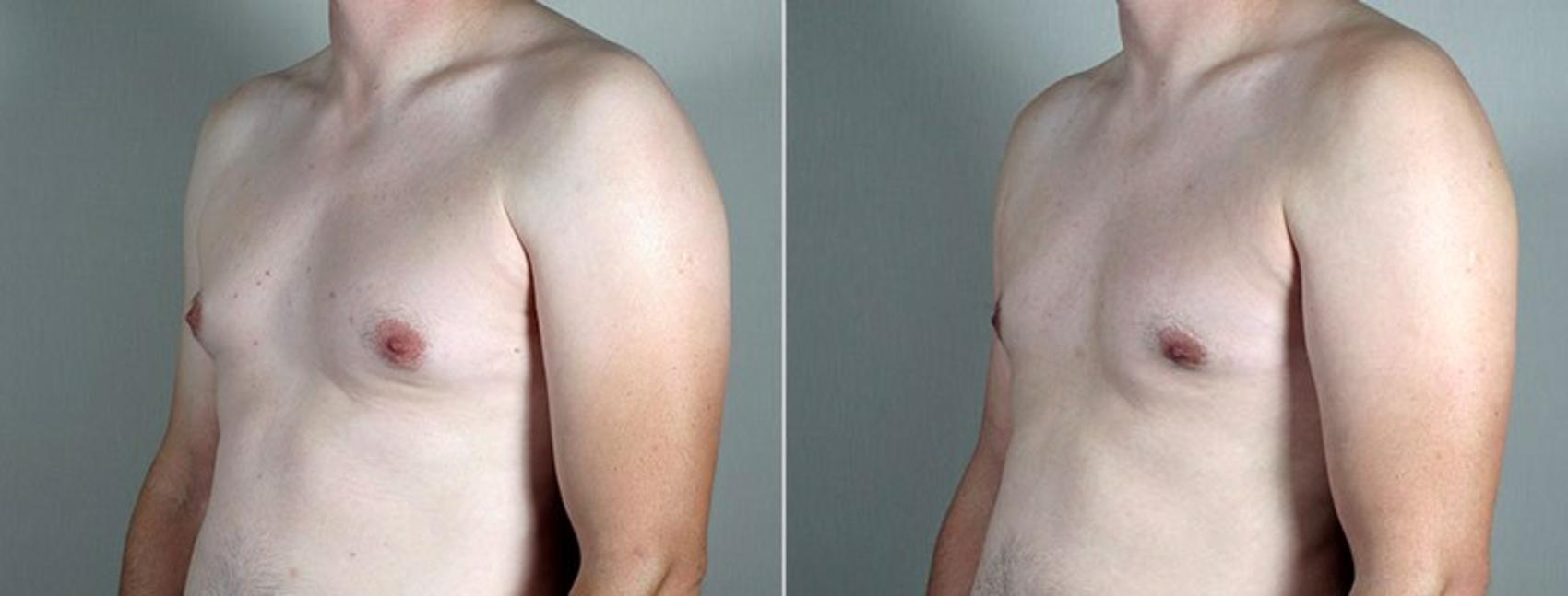 Gynecomastia Surgery Case 665 Before & After View #1 | Paramus, New Jersey | Parker Center for Plastic Surgery