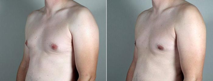 Gynecomastia Surgery Case 665 Before & After View #1 | Paramus, New Jersey | Parker Center for Plastic Surgery