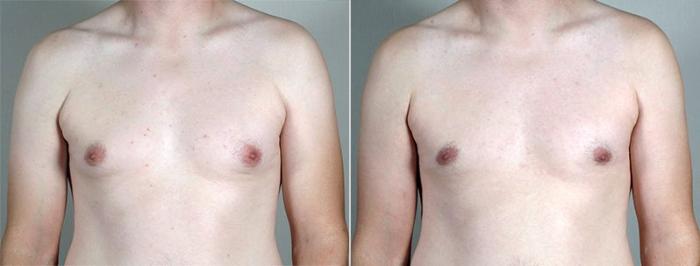 Gynecomastia Surgery Case 665 Before & After View #2 | Paramus, New Jersey | Parker Center for Plastic Surgery