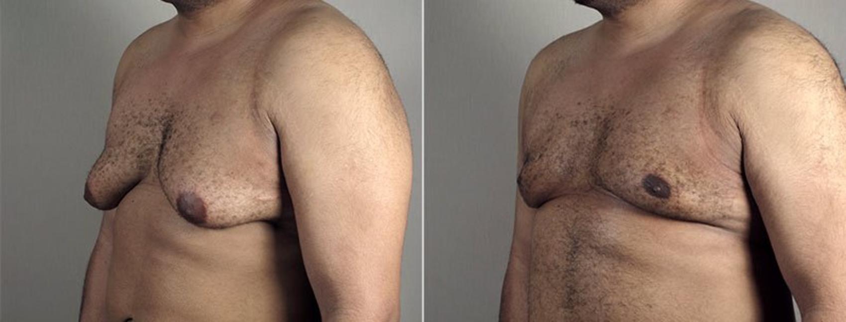 Gynecomastia Surgery Case 666 Before & After View #1 | Paramus, New Jersey | Parker Center for Plastic Surgery