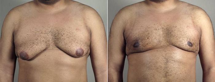 Gynecomastia Surgery Case 666 Before & After View #2 | Paramus, New Jersey | Parker Center for Plastic Surgery