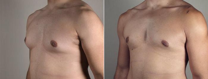 Gynecomastia Surgery Case 667 Before & After View #1 | Paramus, New Jersey | Parker Center for Plastic Surgery