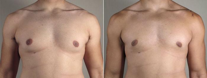 Gynecomastia Surgery Case 667 Before & After View #2 | Paramus, New Jersey | Parker Center for Plastic Surgery