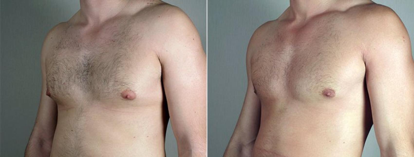 Gynecomastia Surgery Case 668 Before & After View #1 | Paramus, New Jersey | Parker Center for Plastic Surgery