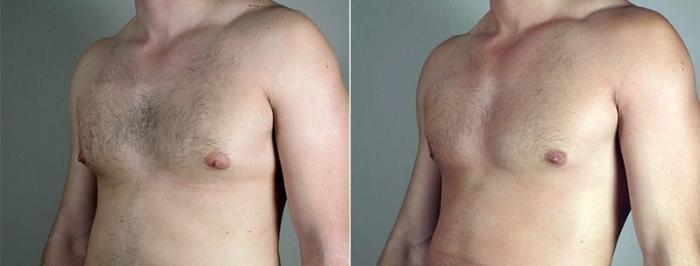 Gynecomastia Surgery Case 668 Before & After View #1 | Paramus, New Jersey | Parker Center for Plastic Surgery
