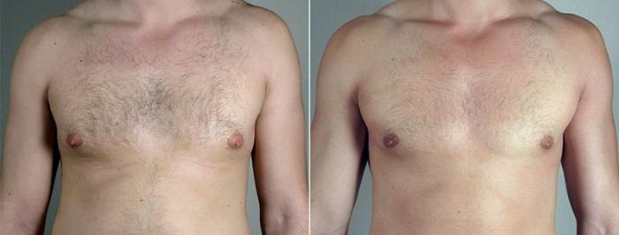 Gynecomastia Surgery Case 668 Before & After View #2 | Paramus, New Jersey | Parker Center for Plastic Surgery