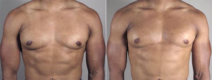 Gynecomastia Surgery Case 670 Before & After View #1 | Paramus, New Jersey | Parker Center for Plastic Surgery