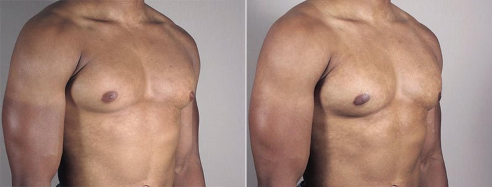 Gynecomastia Surgery Case 670 Before & After View #2 | Paramus, New Jersey | Parker Center for Plastic Surgery