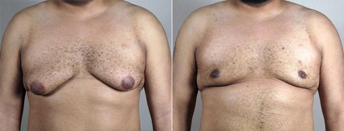 Gynecomastia Surgery Case 671 Before & After View #1 | Paramus, New Jersey | Parker Center for Plastic Surgery