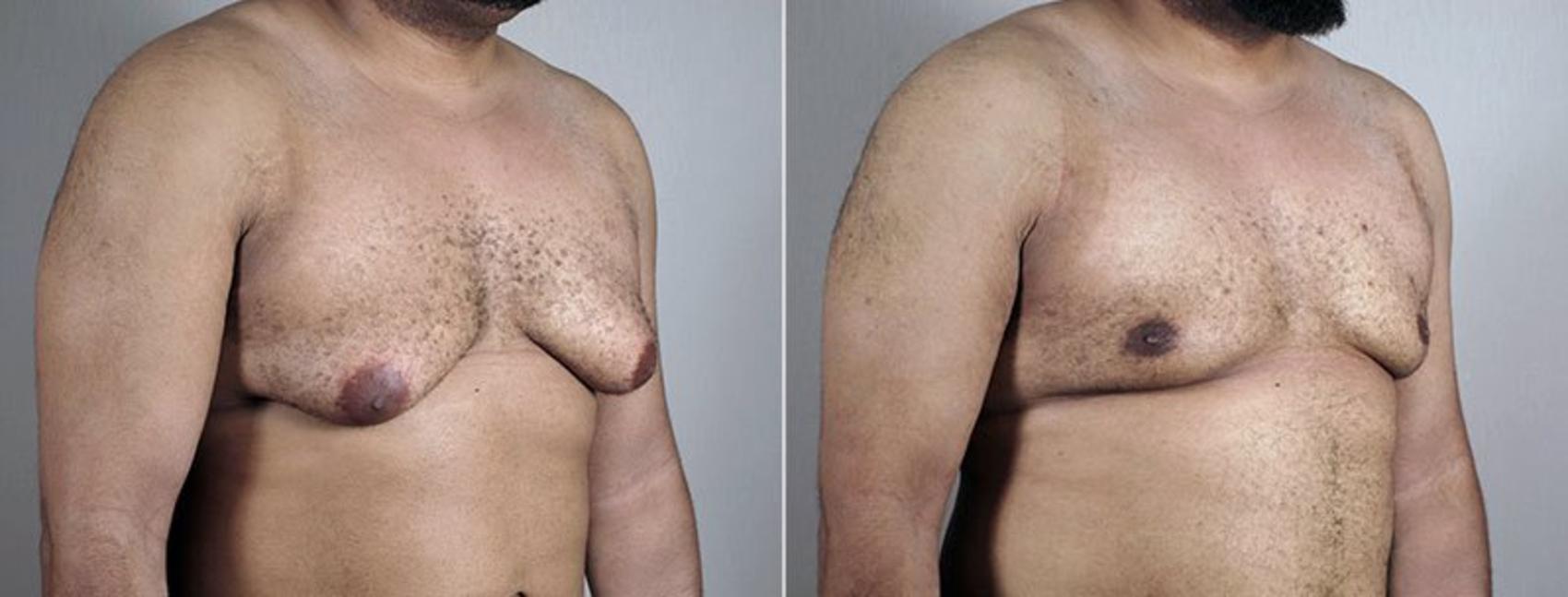 Gynecomastia Surgery Case 671 Before & After View #2 | Paramus, New Jersey | Parker Center for Plastic Surgery