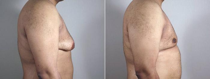 Gynecomastia Surgery Case 671 Before & After View #3 | Paramus, New Jersey | Parker Center for Plastic Surgery