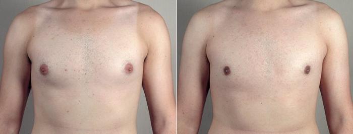 Gynecomastia Surgery Case 672 Before & After View #1 | Paramus, New Jersey | Parker Center for Plastic Surgery