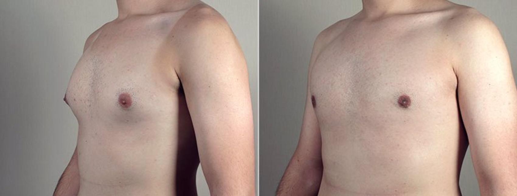Gynecomastia Surgery Case 672 Before & After View #2 | Paramus, New Jersey | Parker Center for Plastic Surgery