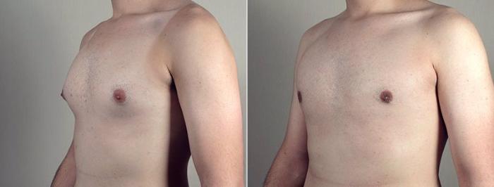 Gynecomastia Surgery Case 672 Before & After View #2 | Paramus, New Jersey | Parker Center for Plastic Surgery