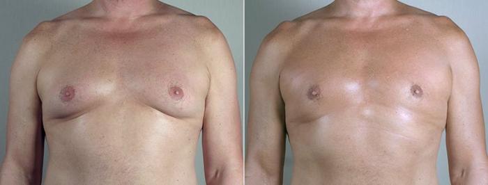 Gynecomastia Surgery Case 674 Before & After View #1 | Paramus, New Jersey | Parker Center for Plastic Surgery