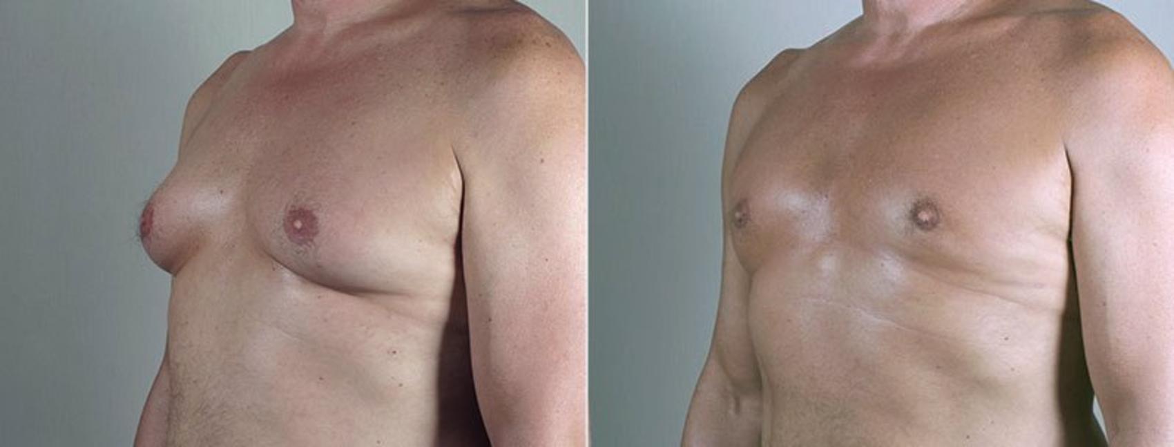 Gynecomastia Surgery Case 674 Before & After View #2 | Paramus, New Jersey | Parker Center for Plastic Surgery