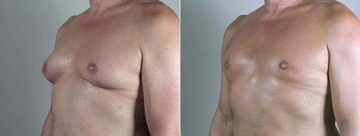 Gynecomastia Surgery Case 674 Before & After View #2 | Paramus, New Jersey | Parker Center for Plastic Surgery