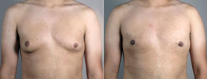 Gynecomastia Surgery Case 677 Before & After View #1 | Paramus, New Jersey | Parker Center for Plastic Surgery