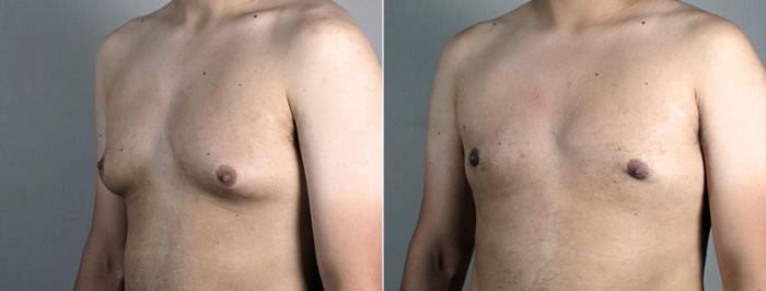 Gynecomastia Surgery Case 677 Before & After View #2 | Paramus, New Jersey | Parker Center for Plastic Surgery