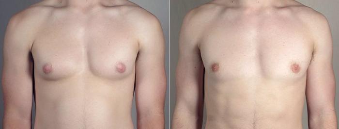Gynecomastia Surgery Case 678 Before & After View #1 | Paramus, New Jersey | Parker Center for Plastic Surgery