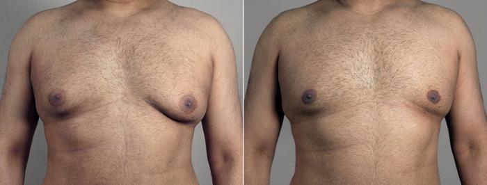 Gynecomastia Surgery Case 679 Before & After View #1 | Paramus, New Jersey | Parker Center for Plastic Surgery