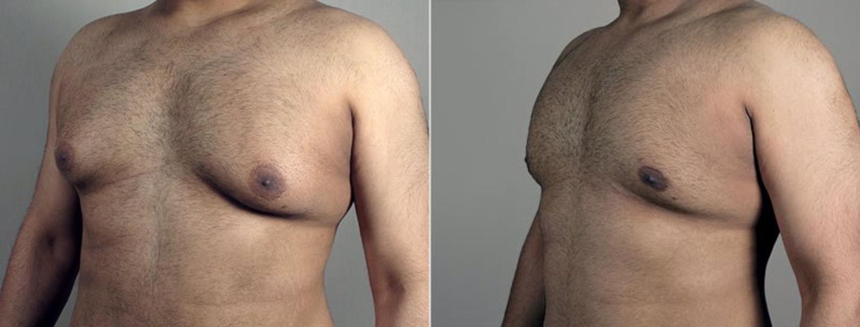 Gynecomastia Surgery Case 679 Before & After View #2 | Paramus, New Jersey | Parker Center for Plastic Surgery