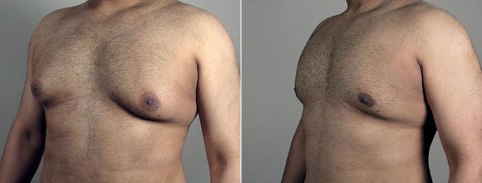 Gynecomastia Surgery Case 679 Before & After View #2 | Paramus, New Jersey | Parker Center for Plastic Surgery