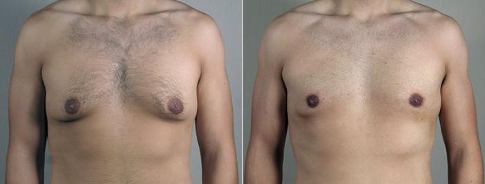 Gynecomastia Surgery Case 680 Before & After View #1 | Paramus, New Jersey | Parker Center for Plastic Surgery