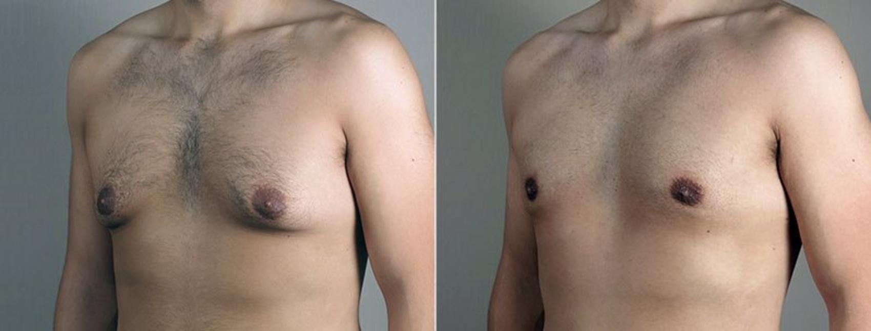 Gynecomastia Surgery Case 680 Before & After View #2 | Paramus, New Jersey | Parker Center for Plastic Surgery