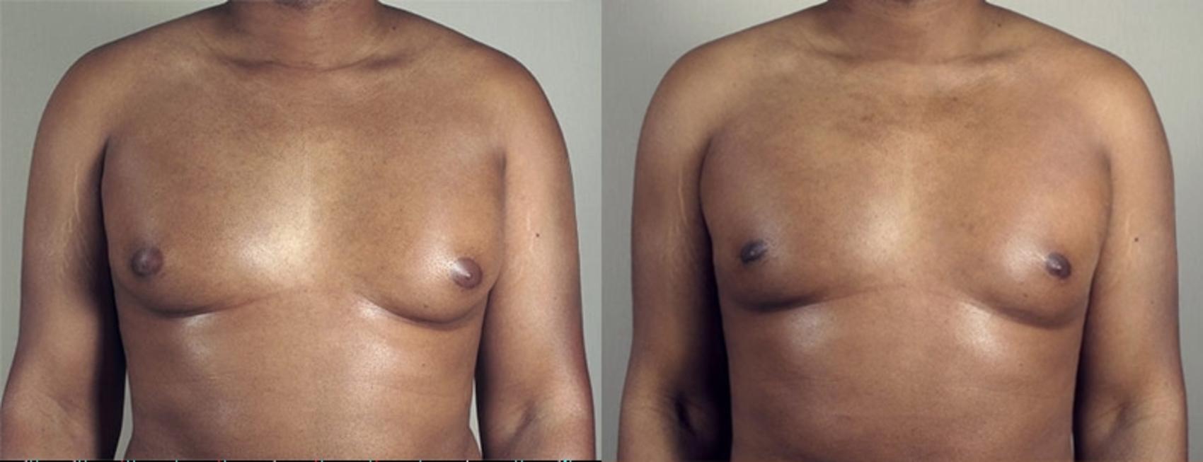 Gynecomastia Surgery Case 940 Before & After View #5 | Paramus, New Jersey | Parker Center for Plastic Surgery