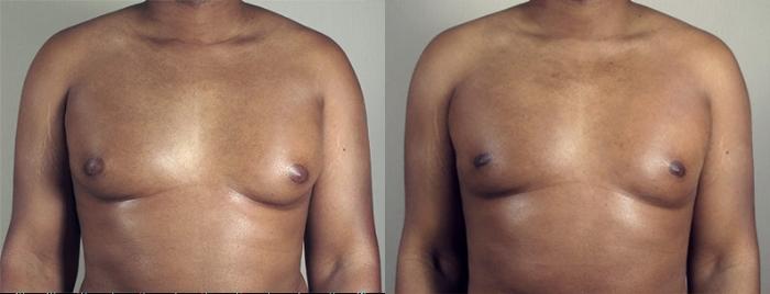 Gynecomastia Surgery Case 940 Before & After View #5 | Paramus, New Jersey | Parker Center for Plastic Surgery