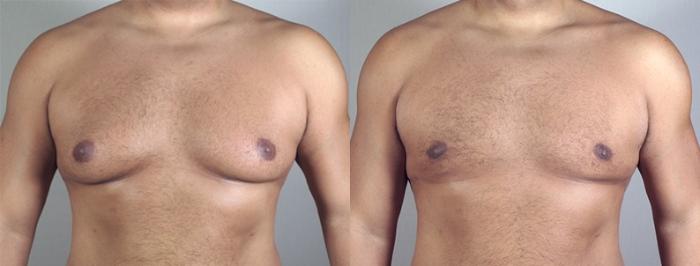 Gynecomastia Surgery Case 943 Before & After Front | Paramus, New Jersey | Parker Center for Plastic Surgery