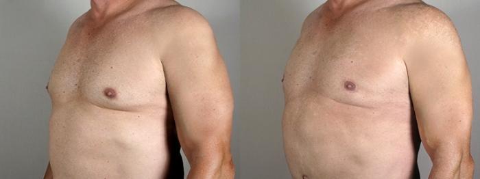 Gynecomastia Surgery Case 944 Before & After View #5 | Paramus, New Jersey | Parker Center for Plastic Surgery