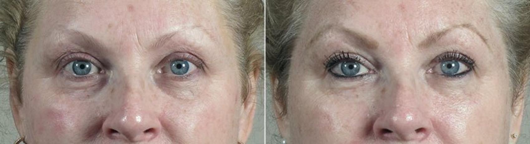 Halo™ Hybrid Fractional Case 303 Before & After View #1 | Paramus, New Jersey | Parker Center for Plastic Surgery