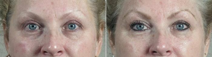 Halo™ Hybrid Fractional Case 303 Before & After View #1 | Paramus, New Jersey | Parker Center for Plastic Surgery